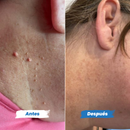 DermaClear™ – Removedor de Verrugas